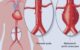 Abdominal aortic aneurysm