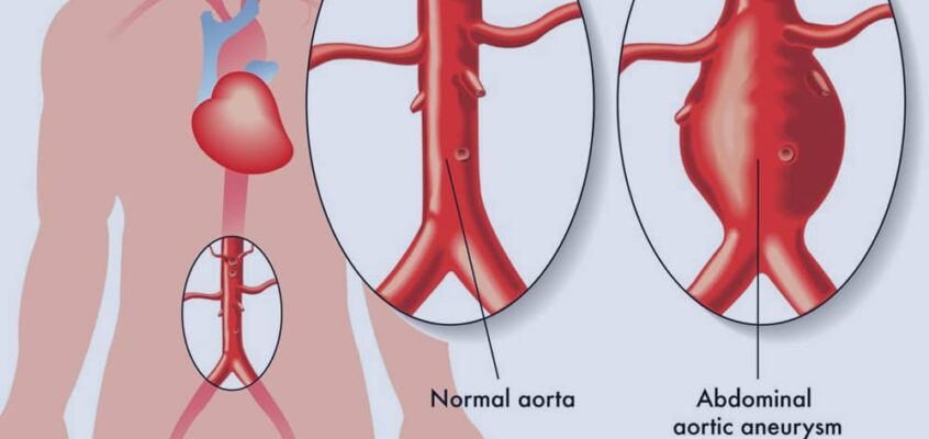 What is an Aneurysm?