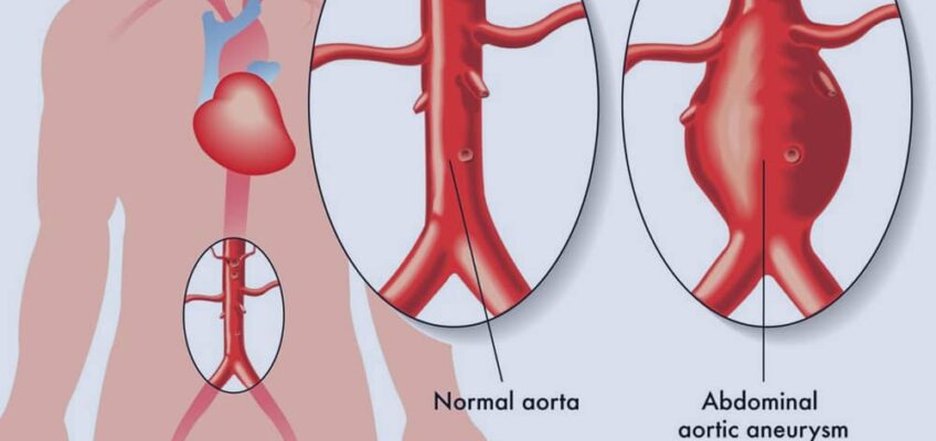 Abdominal aortic aneurysm